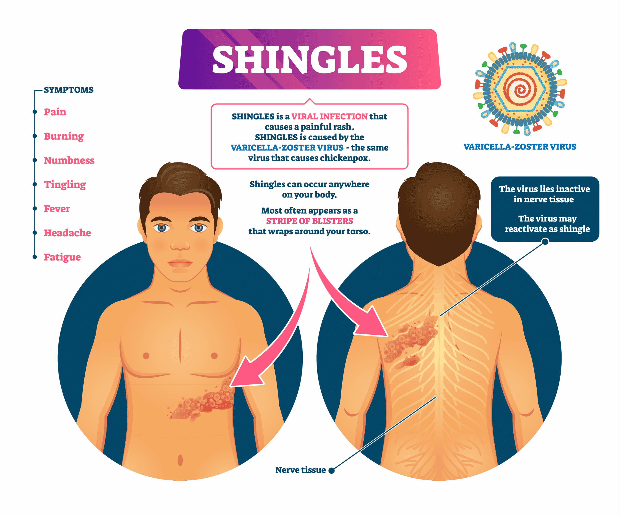 Shingles Stmptoms : Can I Still Get Herpes Zoster Shingles After ...