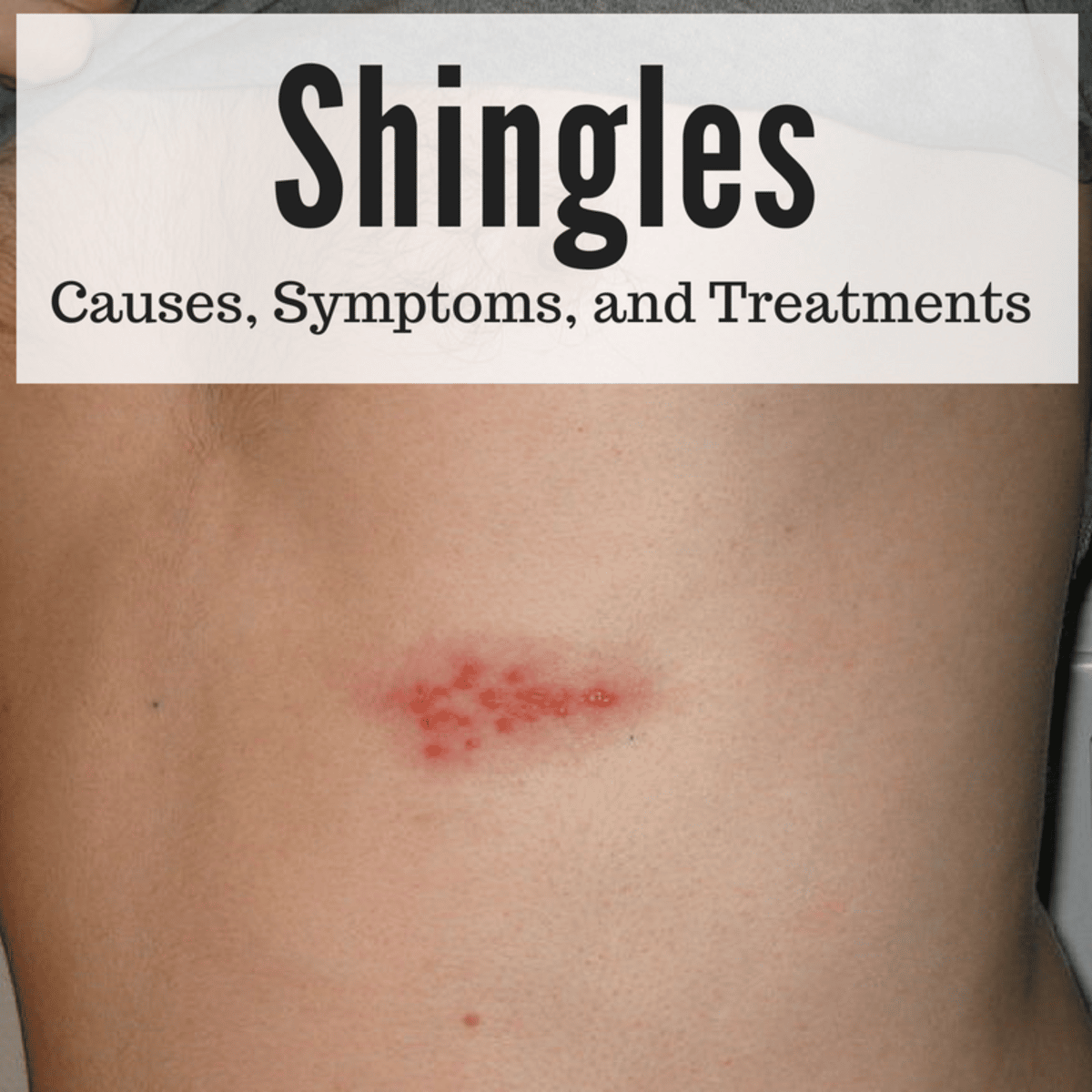Shingles Stmptoms