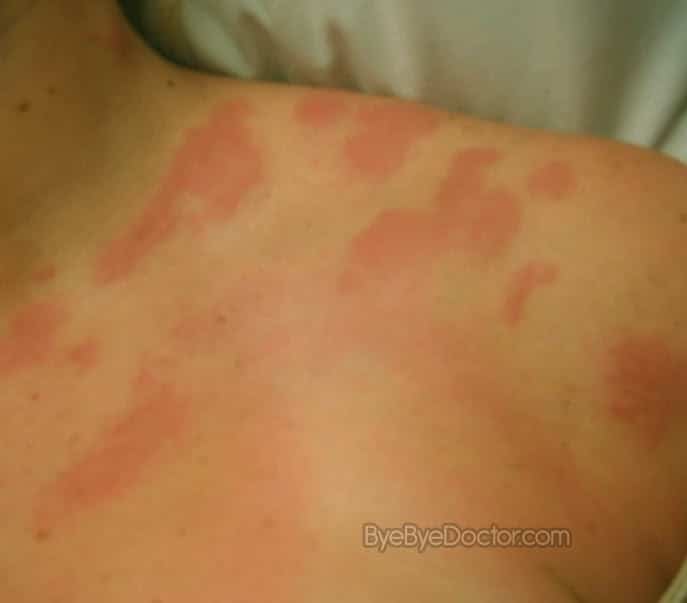 Shingles  Symptoms, Causes, Treatment, Contagious, Pictures ...