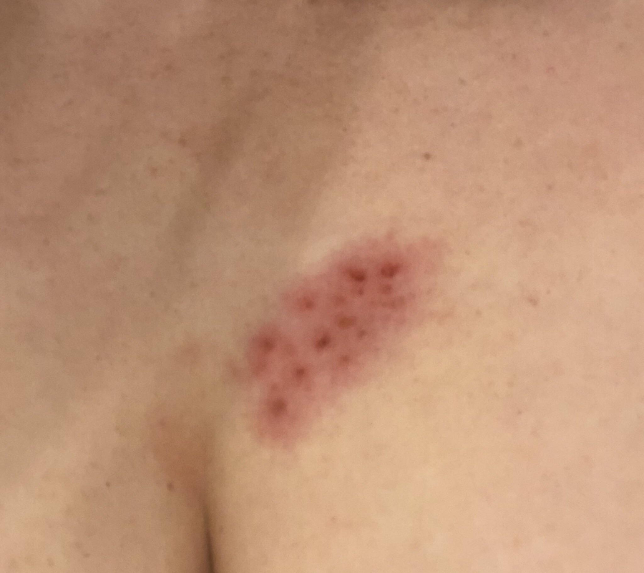 Shingles Update! Since you guys diagnosed correctly I thought I would ...
