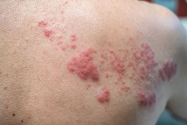 Shingles vaccine push for winter months