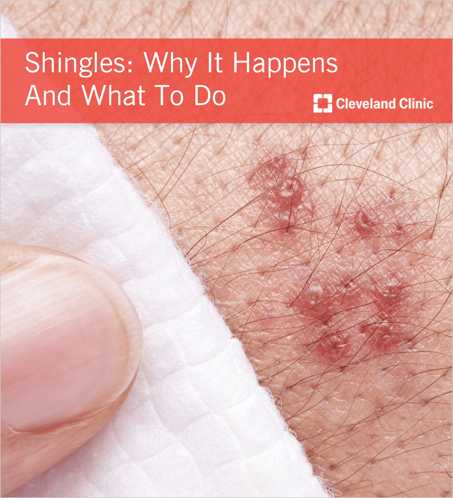 Shingles: What You Should Do If the Chicken Pox Virus Returns