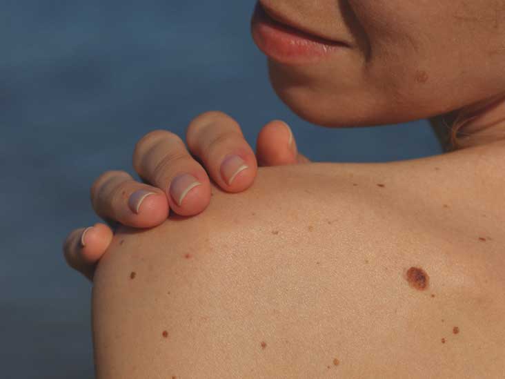 Shingles Without a Rash: What You Should Know