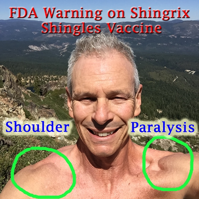 Shingrix Second Dose Side Effects Worse
