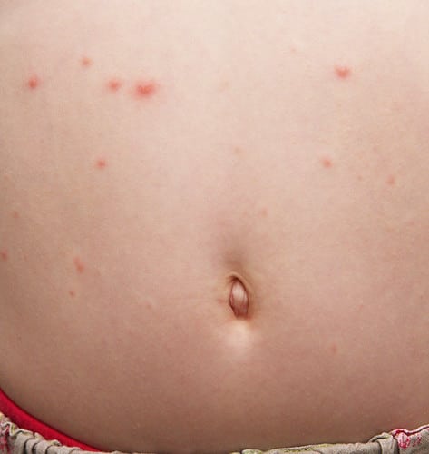 Side Effects On Chicken Pox