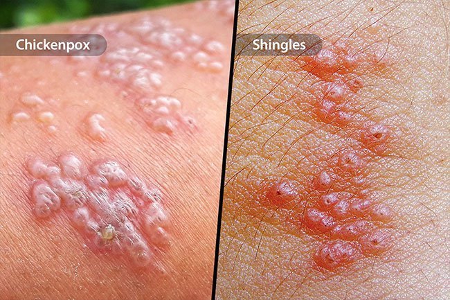 Skin Problems: Blisters Causes and Treatment