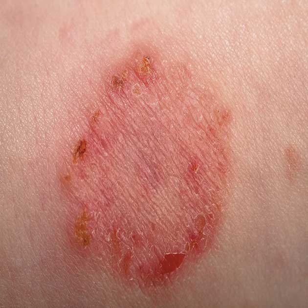 Skin problems can be sorted when you know what they are