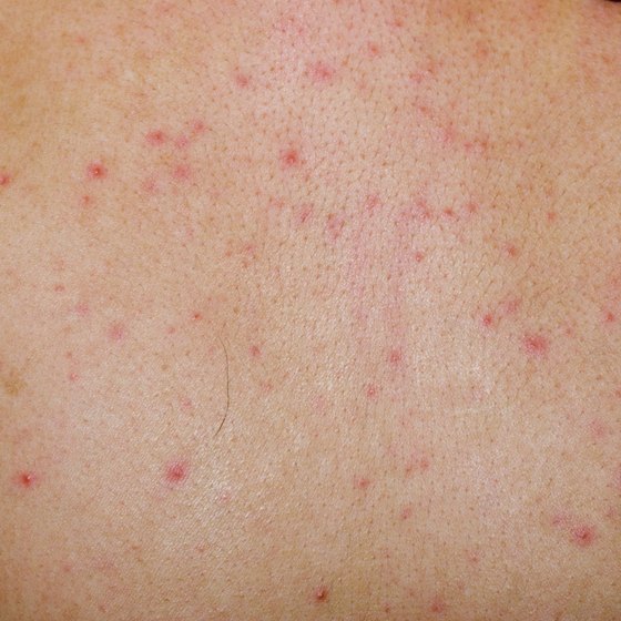 Skin Rashes Caused by Viral Infection