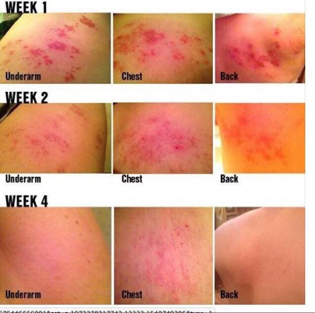 Stages Of Shingles Rash Pictures