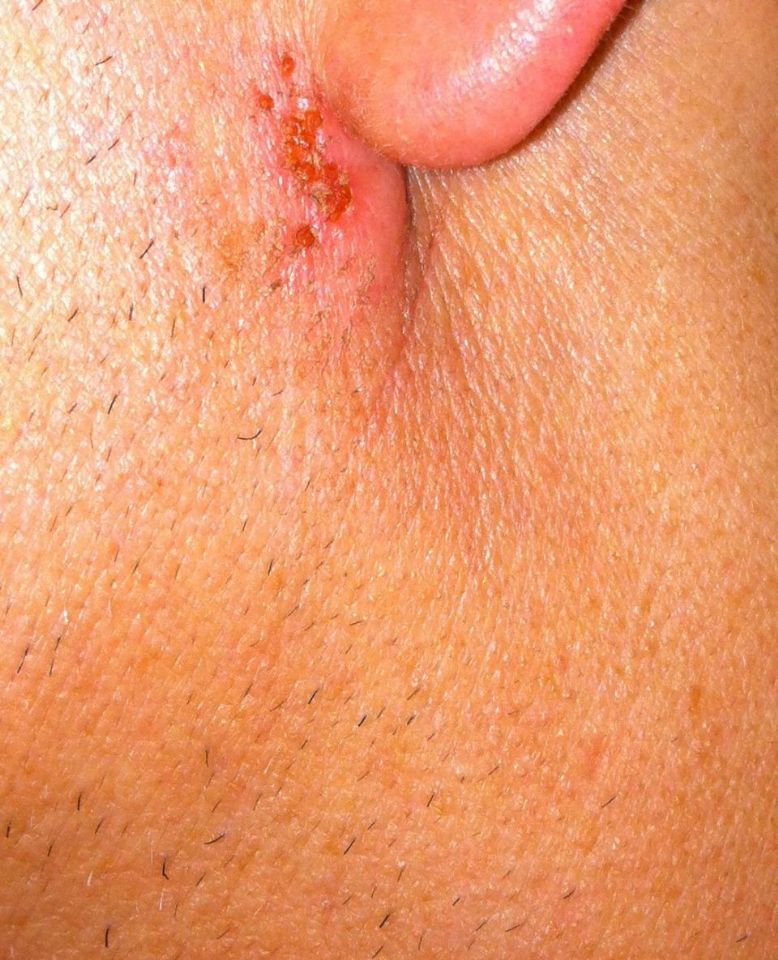 Strange rash below earlobe. Could this be Shingles? at The Truth in ...