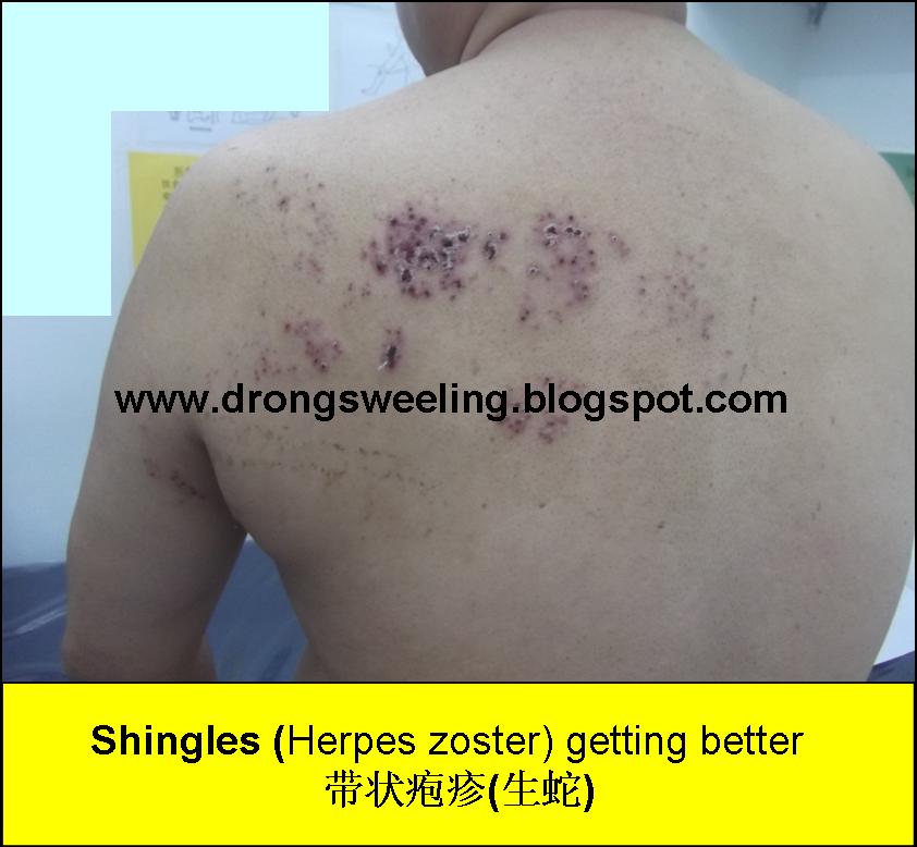 TCM News: Best TCM Doctor for Shingles, Herpes Zoster, Postherpetic ...