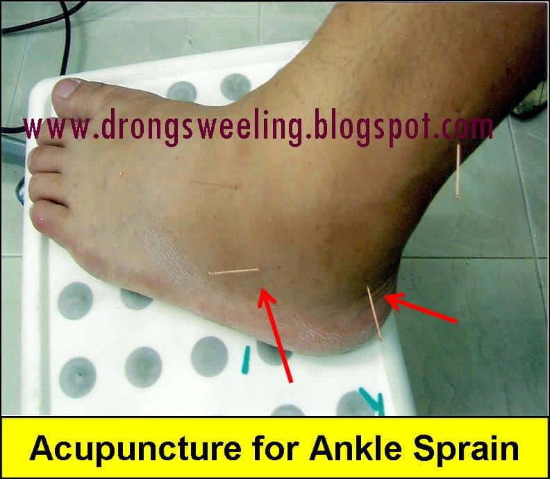 TCM News: TCM Clinic in Singapore Treat Sprain &  Leg Injury