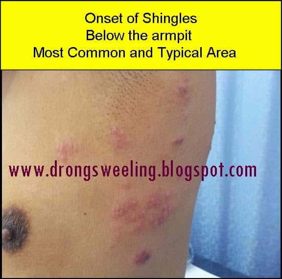 TCM News: TCM Physician Cure Shingles (Herpes Zoster), Postherpetic ...