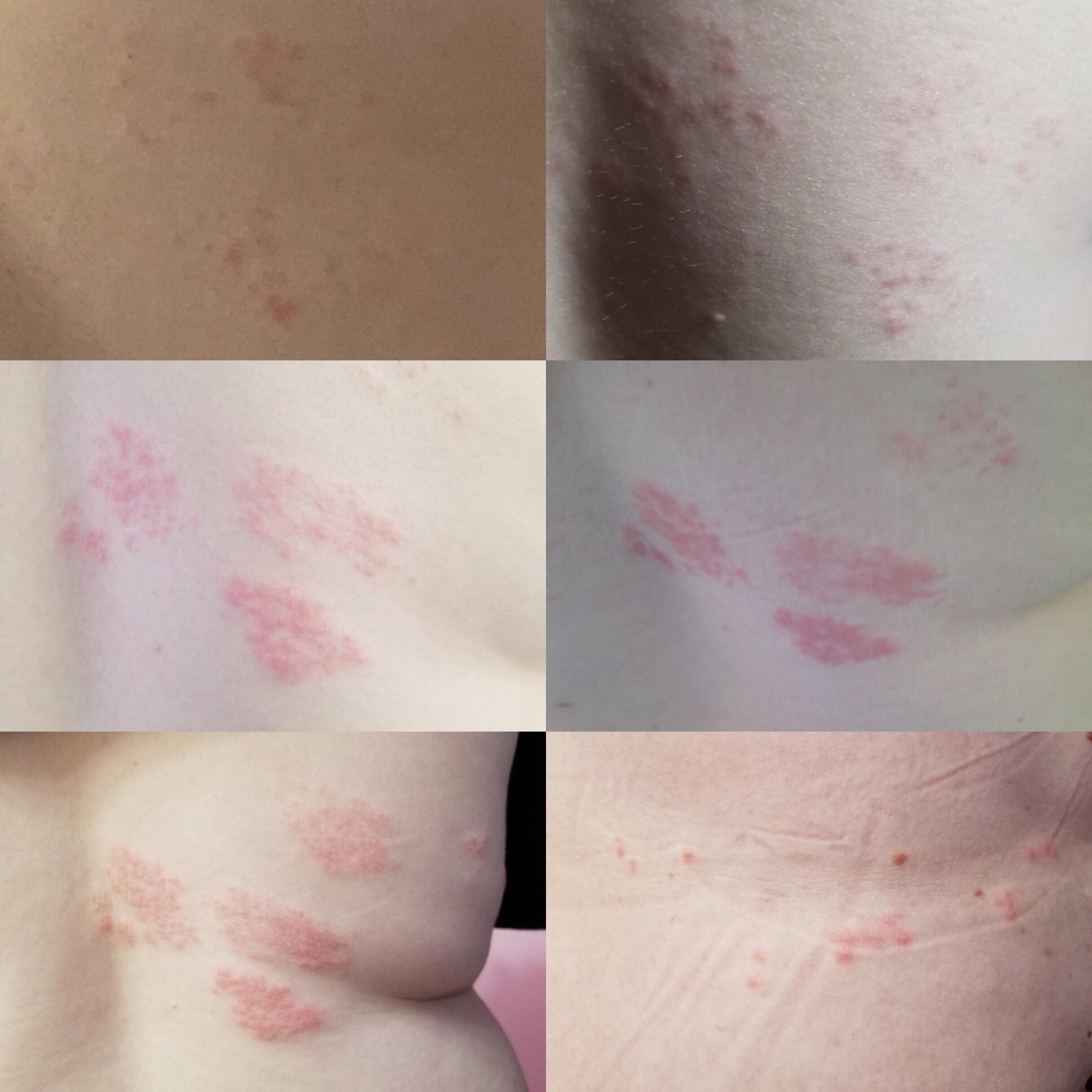The progression of shingles over the last two weeks. Started out on my ...