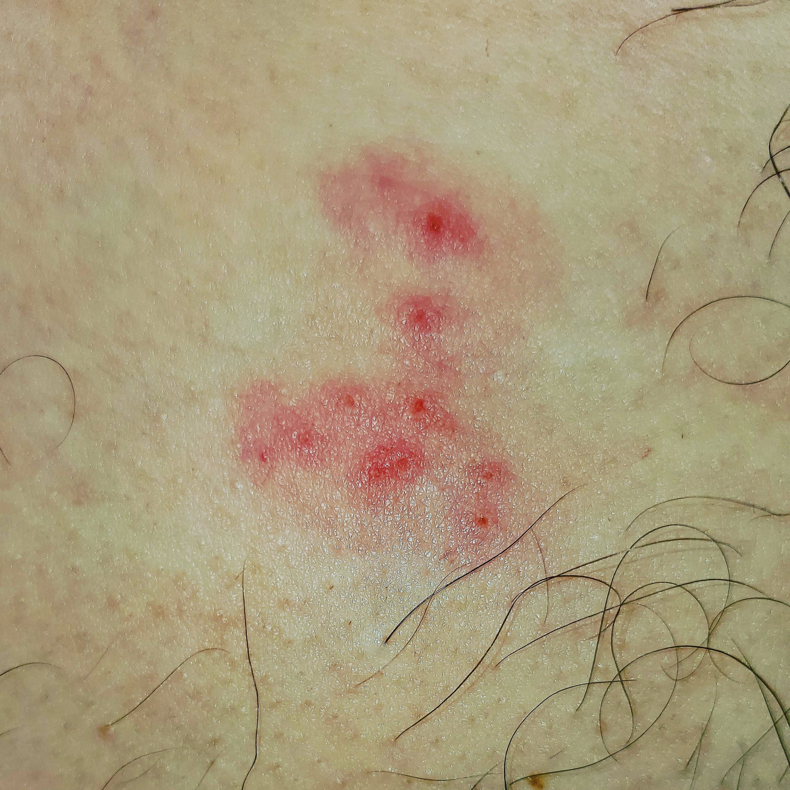 These burn and itch so bad  : shingles