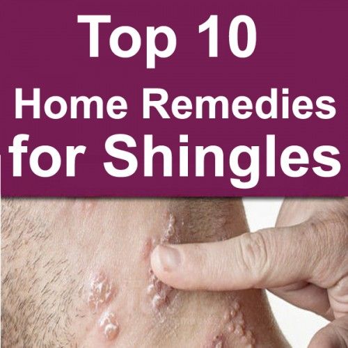 Top 10 Home Remedies for Shingles