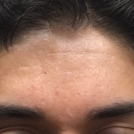 Treatment for my forehead scars?
