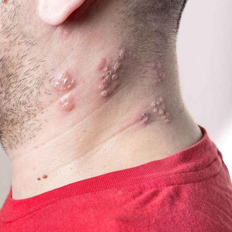 What Are the Common Causes of a Flaky Rash? (with pictures)