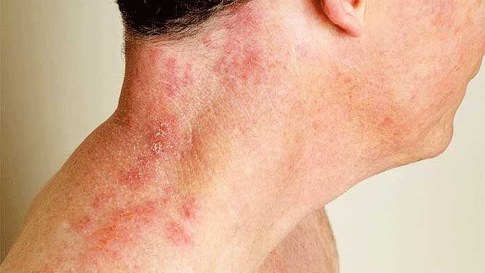 What Are The Symptoms Of Internal Shingles? Without Rash