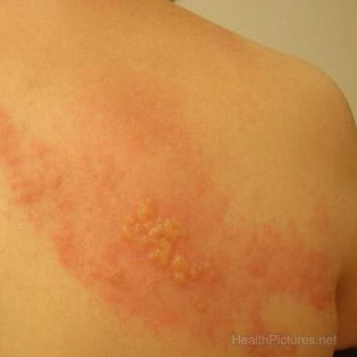 What Does Early Stage Shingles Look Like
