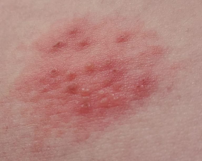 What Does Early Stages Of Shingles Look Like