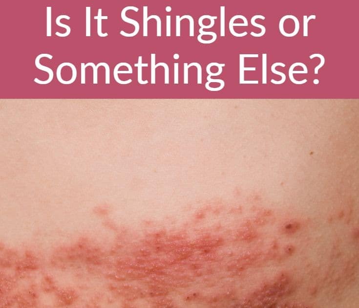 What Does Shingles Look Like On A Black Person