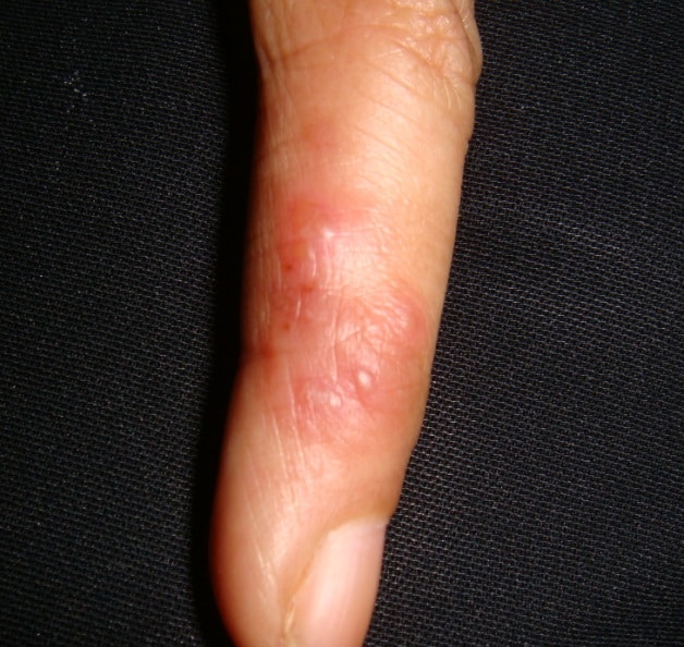 What Does Shingles Look Like On Hands