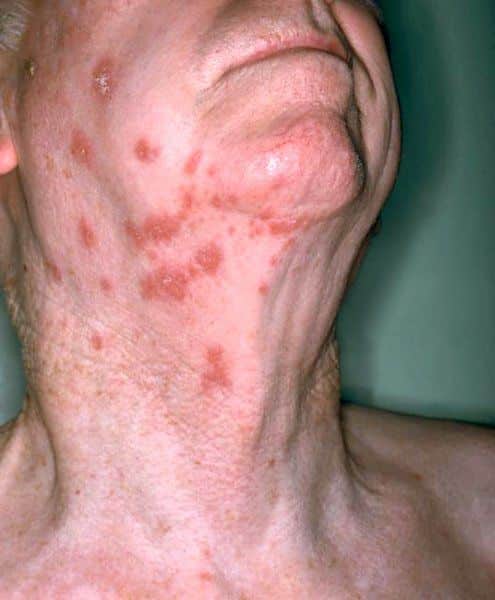 What Is The Disease Called Shingles