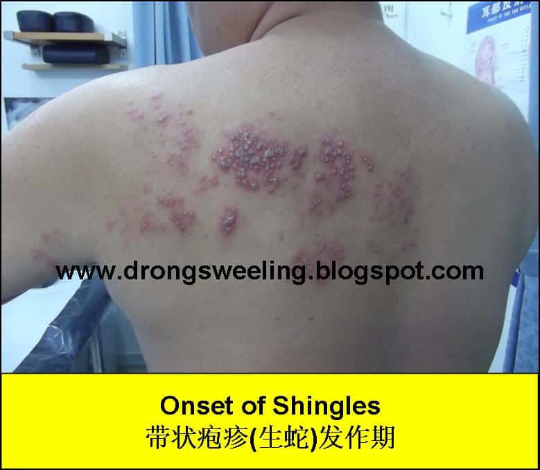 What Kind Of Doctor To See For Shingles