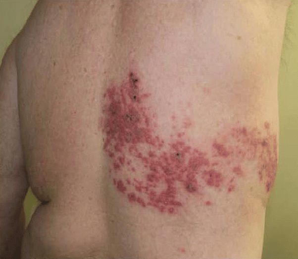 What makes the virus reactivate to cause shingles in people who have ...