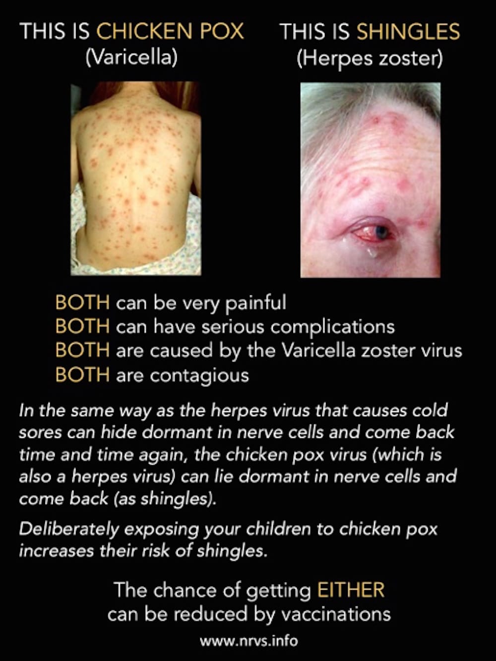why chickenpox isn